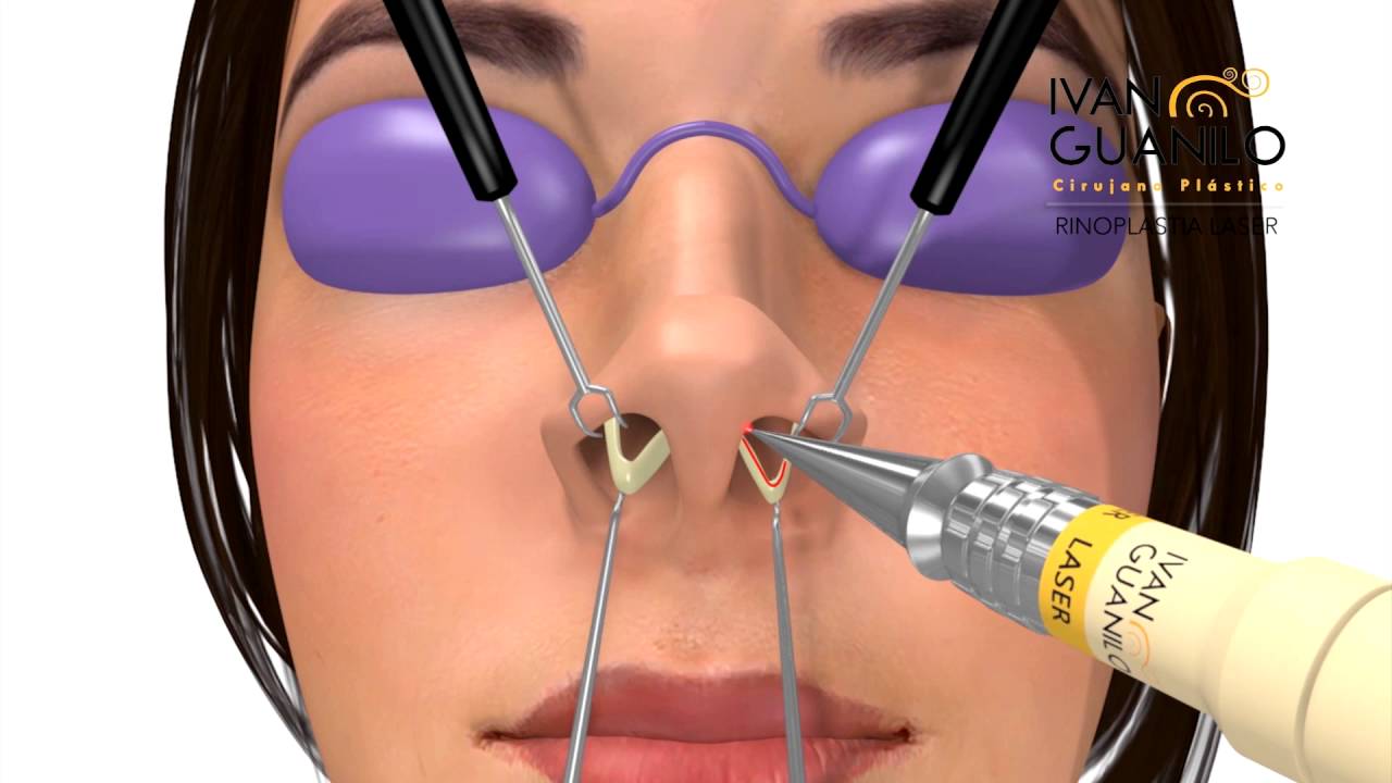 Cirugia laser nariz