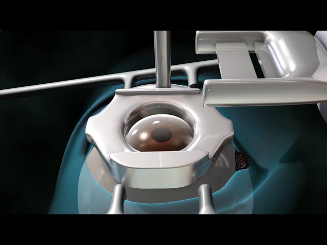 Cirugia ocular con laser